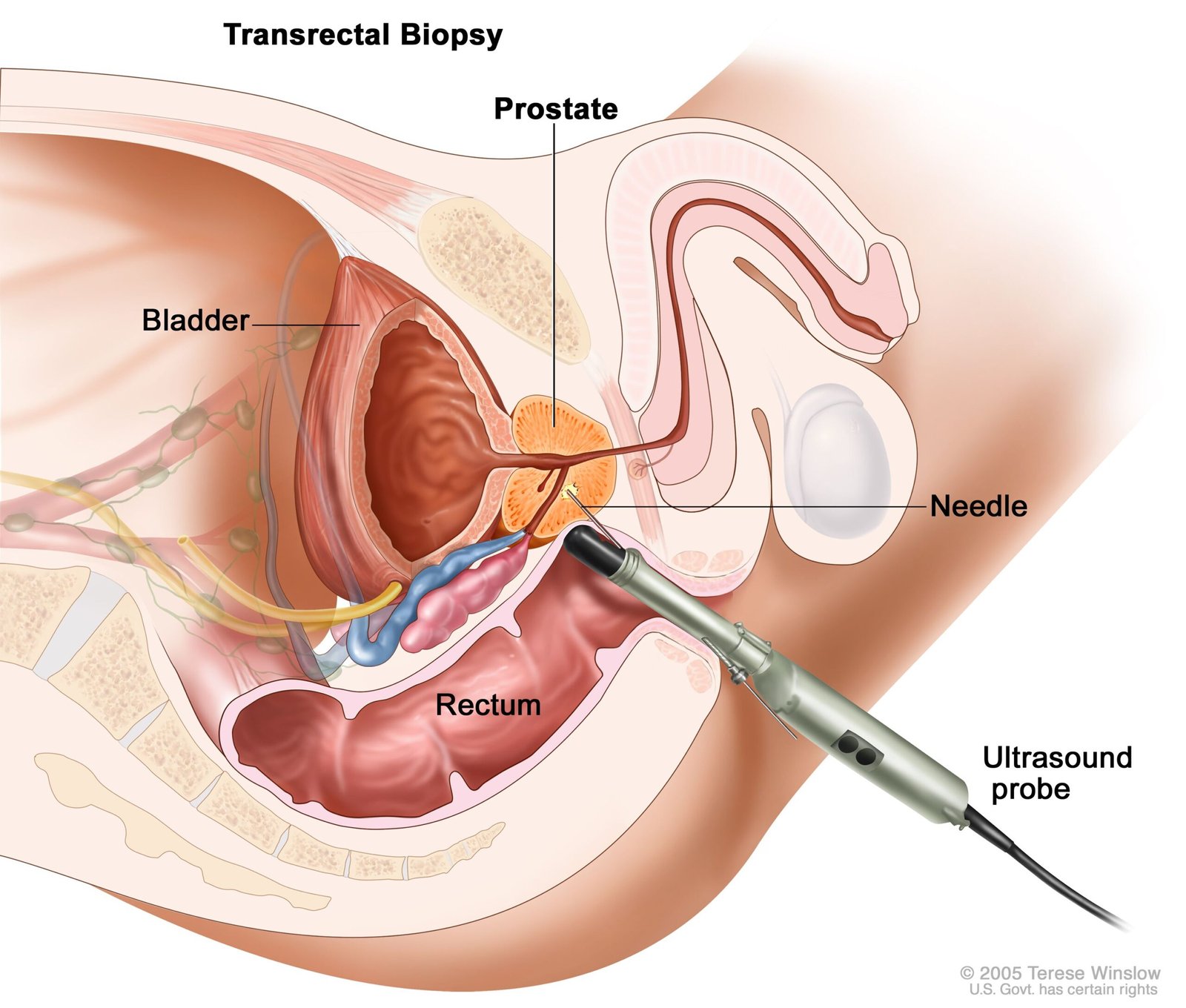 Prostate biopsy being conducted at Scanova Imaging Center in Aurangabad by Dr. Sanket Sarda.